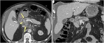 Unfortunately, pancreatic cancer usually shows little or no symptoms until it has advanced and spread. Mass Forming Pancreatitis Versus Pancreatic Ductal Adenocarcinoma Ct And Mr Imaging For Differentiation Cancer Imaging Full Text
