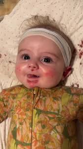 Butterfly Baby: Understanding Epidermolysis Bullosa