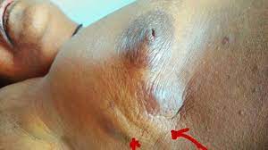 Most patients who choose lumpectomy will also be treated with radiation therapy to minimize the chance of recurrence of the cancer in the breast. 7 Pictures Of Breast Cancer