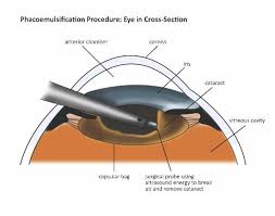 Image result for Cataract Extraction