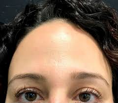 La canción del final, aquí: Botox O Toxina Botulinica En Aa Clinic