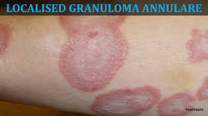 They are not accompanied by rheumatoid factors or bone erosions, but are associated with concomitant joint diseases. Granuloma Annulare Youtube