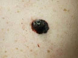 Image result for Spitz Nevus