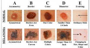 Give to kids with cancer today > Skin Cancer Part 3 Of 3 Check Your Skin Wellness Advice And Prayers From The Road
