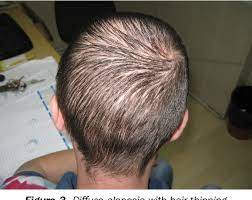 The protease inhibitor class, in particular indinavir, was most commonly reported to cause hair loss, followed by the nrti, lamivudine. Diffuse Hair Loss In Secondary Syphilis In Hiv Positive Man Case Report Semantic Scholar