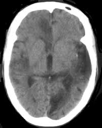 Image result for Neurosyphilis