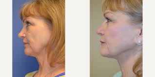 F. Mark Owsley, MD, Board Certified Plastic Surgeon