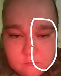 How long after sinus surgery can you be 100% back to yourself?