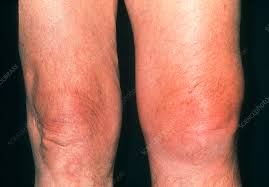 Image result for gout symptoms knee