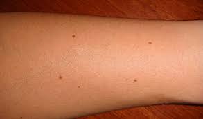 Lucky And Unlucky Moles On Body Parts Of Male And Female Indian Palm Reading Hast Rekha Gyan lucky and unlucky moles on body parts