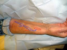 Pin On Interventional Radiology Tools