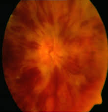 Santral Retinal Ven Tikanikligi Prof Dr Ziya Kapran