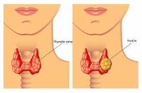 Le traitement repose sur un suivi clinique régulier avec des examens et des échographies. Nodule Thyroidien Causes Symptomes Et Ponction