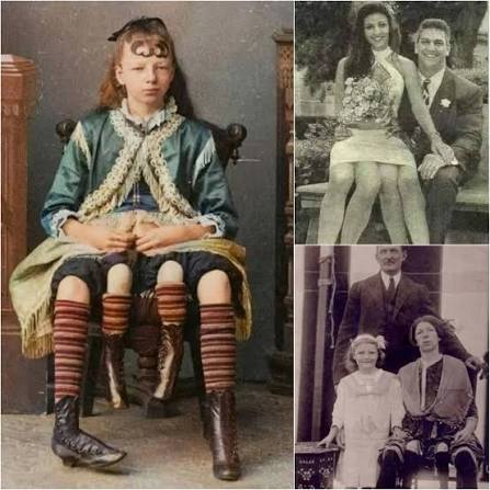 Myrtle Corbin was a young girl born in 1868 in Texas with a rare congenital  condition known as dipygus, which resulted in her having four legs. This  condition occurs when twins are