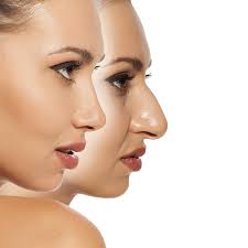 Appearance can be improved for those people who are dissatisfied with the shape and size of. Rhinoplasty Nose Reshape Surgery Abu Dhabi Nose Job Plastic Surgery