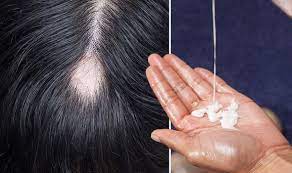 Melatonin is a naturally occurring hormone that's associated with sleep, but did you know current research also shows it may help with hair growth?in this vi. Hair Loss Treatment Melatonin Shown To Help Express Co Uk