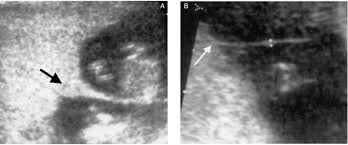 Lambda (uppercase λ, lowercase λ) is the 11th letter of the greek alphabet. Monochorionic Twin Pregnancy Potential Risks And Perinatal Outcomes Intechopen