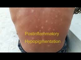 Image result for Postinflammatory Hypopigmentation