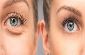 Maybe you would like to learn more about one of these? Top Tips To Get Rid Of Dark Circles Sunken Eyes The Cosmetic Skin Clinic