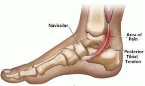 The 4 Best Posterior Tibial Tendonitis Brace Exercises