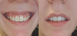 A gummy smile can be fixed. 7 Months Gummy Smile Getting More Noticeable As My Teeth Get Straighter Does Anyone Have Similar Gumness That Has Been Fixed Braces