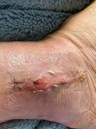 We did not find results for: Sarah On Twitter Oh Wow Didn T Realize The Cast Went On Hot I Was Attributing The Peeling Skin To Rising Sutures This Is The Weirdest Heal I Ve Ever Had In 22 Orthopedic
