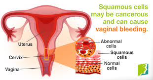 Uterine cancer is not the only cause of vaginal bleeding after menopause. Pin On 34 Menopause Symptoms