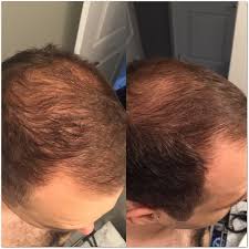It is specially designed to act on follicle dysfunctions to achieve. Revita Shampoo Review Care Your Hair