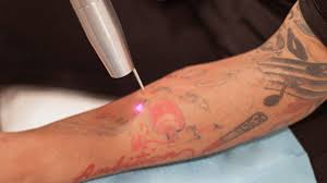Tattoo removal* bioderm skin care & laser center now has a wonderful option for those bothersome tattoos that have now gone out of favor. Tattoo Removal