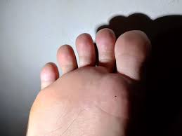 Image result for pompholyx soles of feet