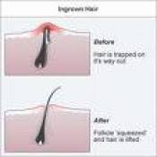 Shave in the same direction as your hair grows (usually, downward) to help prevent ingrown pimples. Popping Ingrown Hairs