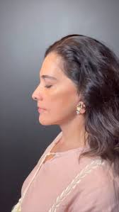 Full Facelift Deep Plane 🤩 before and after 💯