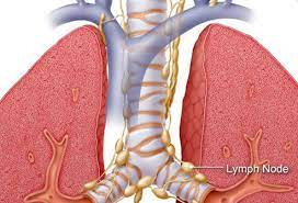 Symptoms of lung cancer develop as the condition progresses. Lung Cancer Early Signs Symptoms Stages