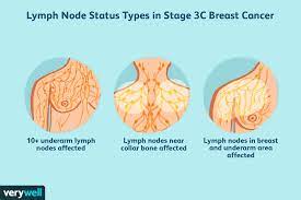 Well, the hope for women with early stage breast cancer is that by using surgery and radiation therapy and, where appropriate, chemotherapy and hormonal treatments, that we can help prevent the. Stage 3 Breast Cancer Types Treatment Survival