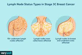 Of course, your specialist is the main person whose advice you should follow but it doesn't do anyone harm. Stage 3 Breast Cancer Types Treatment Survival