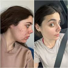 What if I told you I have a product that gives these results with no  chemicals and no ingredients??? Visit my link to my website to order The  Lumi Patch ! Order