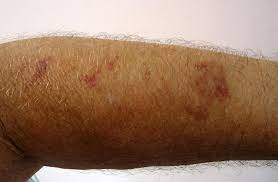 The spots are caused by bleeding underneath the skin secondary to platelet disorders, vascular disorders, coagulation disorders, or other causes. Senile Purpura Causes Symptoms And Diagnosis