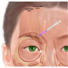 Image result for Forehead Regional Block