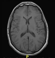 A brain mri study in subject with borderline personality disorders. Mri Scans Detect Brain Rust In Schizophrenia Imaging Technology News