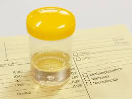 Urine Ph Level Test Purpose Procedure Side Effects
