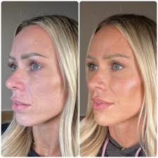 She was already beautiful — but now she looks refreshed and years younger ✨  This gorgeous result was achieved with our 5 syringe package ($2245) with a  small upcharge for Radiesse. Strategic