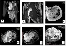 What to look for, where to look & how to report. The Diagnostic Value Of Diffusion Weighted Magnetic Resonance Imaging In Characterization Of Musculoskeletal Soft Tissue Tumors Sciencedirect