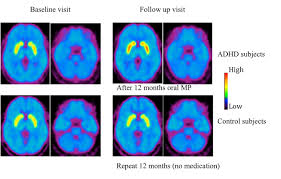 ما هو اضطراب تشتت الانتباة و فرط الحركة؟او attention deficit hyperactivity disorder (adhd)ما هي اسباب فرط الحركة و نقص الانتباه؟ما هي أعراض فرط الحركة و. Ù…Ø±Ø¶Ù‰ Adhd ÙŠØ¸Ù‡Ø±ÙˆÙ† Ø§ØªØµØ§Ù„Ø§Øª Ø£Ø¶Ø¹Ù ÙÙŠ Ø´Ø¨ÙƒØ§Øª Ø§Ù„Ø¯Ù…Ø§Øº Ù…Ø±ØªØ¨Ø·Ø© Ø¨Ø§Ù„ØªØ±ÙƒÙŠØ² Ø¯Ø±Ø§Ø³Ø© Adhd 2021