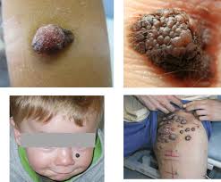 See a dermatologist at least once a year for a professional skin exam. Pediatric Oncology Malignant Melanoma