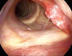 Image result for Reflux Laryngitis