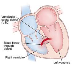 Image result for Ventricular Septal Defect