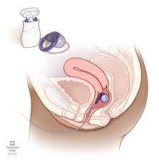 Vaginal Insert Offers Relief from Fecal Incontinence – Consult QD