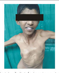Anaesthetic Challenges And Difficult Airway Management In Noonan Syndrome Semantic Scholar