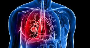 Primary lung tumors have variable signs, which depend on the location of the tumor, rate of tumor growth, and the presence of previous or current lung disease. Surprising Lung Cancer Symptoms