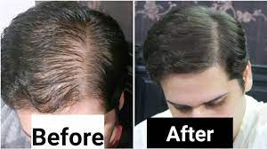 Rosemary oil is known for being one of the best essential hair oils. Rosemary Oil For Hair Loss My Results W Pictures Before After How To Use Youtube